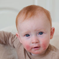 Infant Rash Cow Milk Allergy