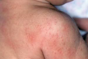 Can Baby Formula Cause Diaper Rash? Uncover the Truth