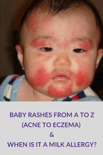 Baby Rashes from A to Z (Acne to Eczema!) and When Is It a Milk Allergy?
