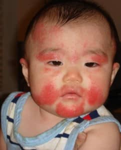 Eczema Rash on Baby Baby rashes